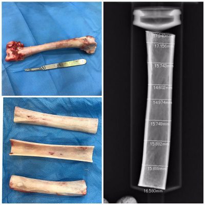 جراحی پیوند استخوان از حیوان تلف شده برای اولین بار در دنیا