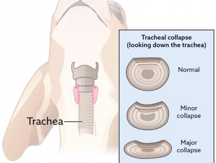 کلاپس نای (Collapse in trachea )